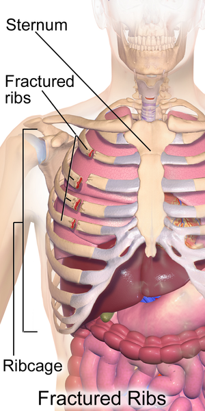 9 possible causes of aching rib cage