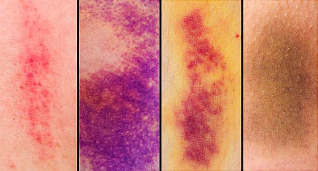 Bruise vs. Hematoma
