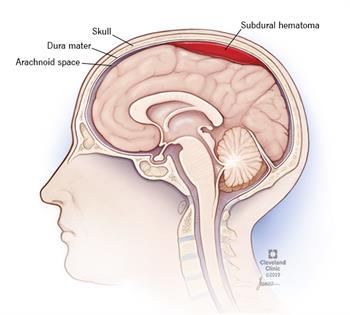 Subdural hematoma: What you need to know