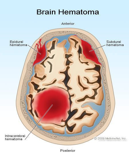 Epidural Hematoma