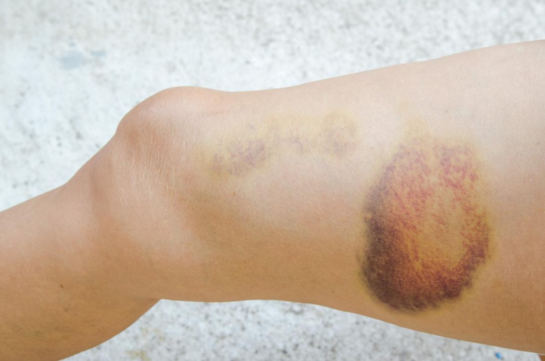 Hematoma in the Leg