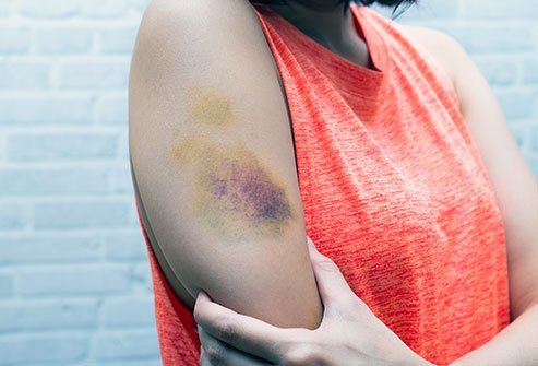 What is a Hematoma?